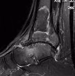 Ankle MRI