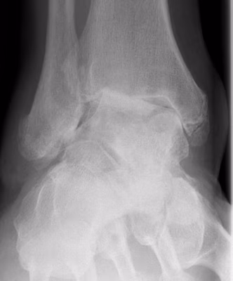 Ankle OA