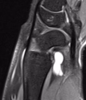 ganglion
