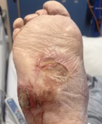 Ulcer