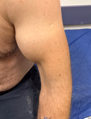 Distal biceps 2