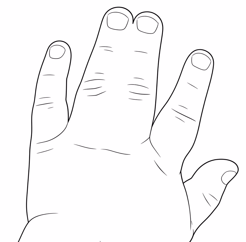 syndactyly