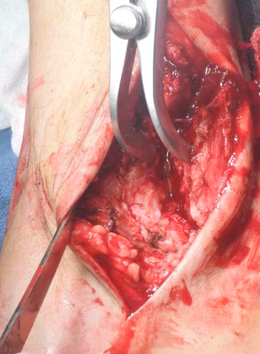 Fibular osteotomy