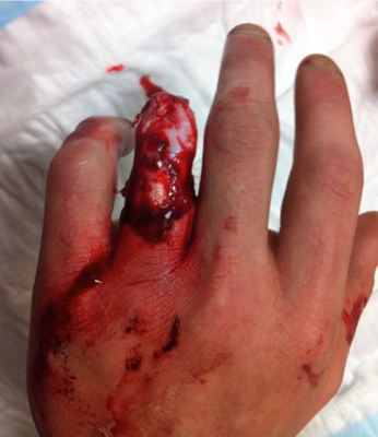 Finger avulsion 1