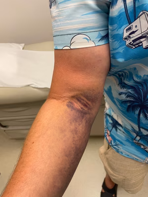 distal biceps