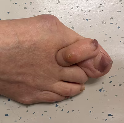 Hammer toe