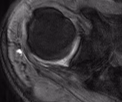 tendinosis