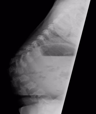 achondroplasia