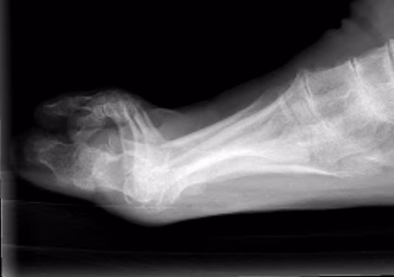 RA foot