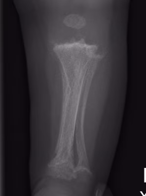 metaphyseal chondrodysplasia