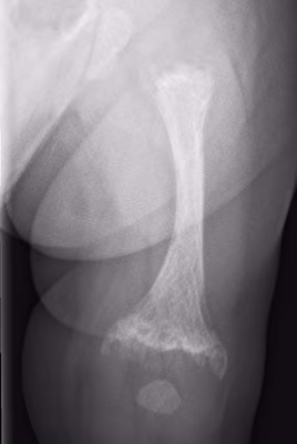metaphyseal chondrodyplasia