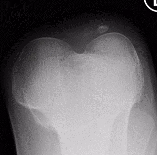 Nail patella syndrome