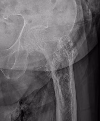 Paget femur