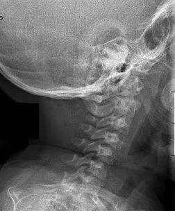 Achondroplasia