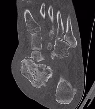 Charcot