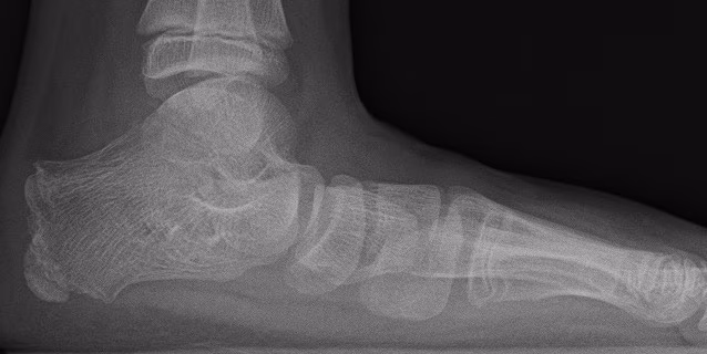 Flat foot