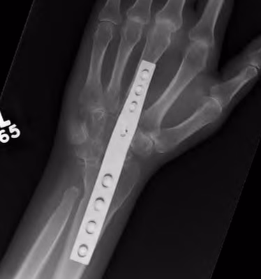 wrist fusion