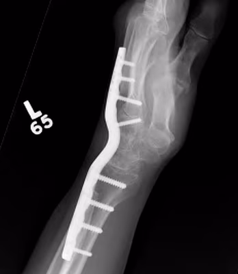 wrist fusion