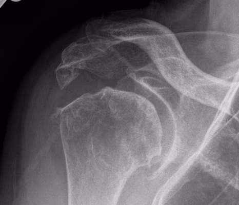 Rheumatoid Shoulder Xray