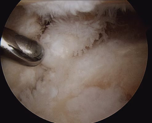 RA arthroscopy shoulder 1