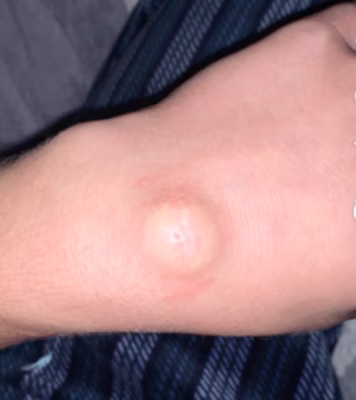 ganglion