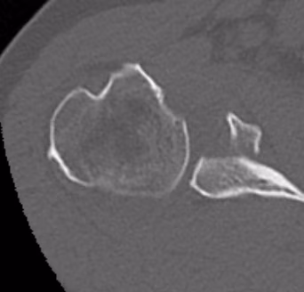 glenoid