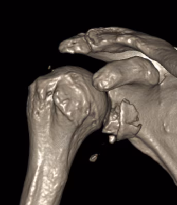 glenoid