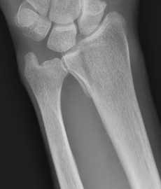 Volar ulna