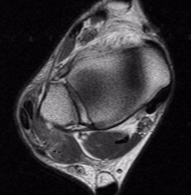 peroneal
