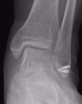 peroneal