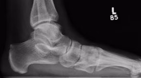 lateral xray