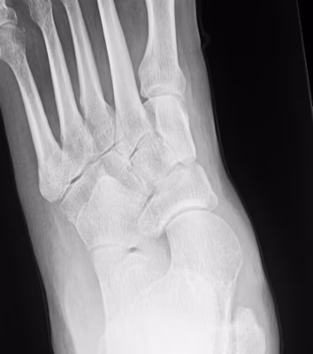 AP foot