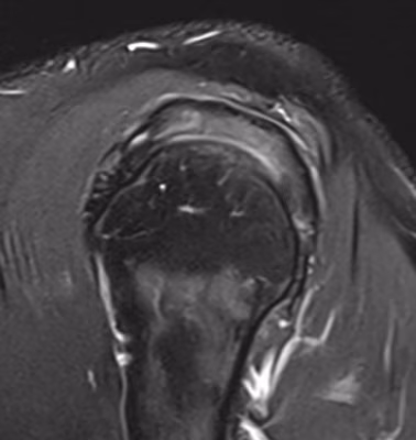 tendinosis