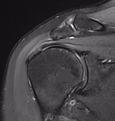 Ss tendinopathy
