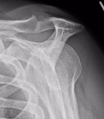 Curved acromion