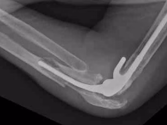 TER fracture