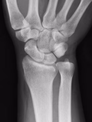 ulna