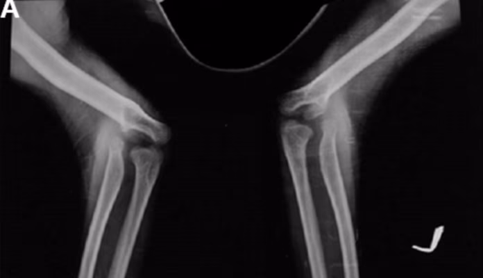 Nail patella