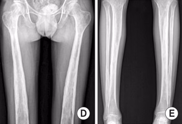 Diaphyseal dysplasia