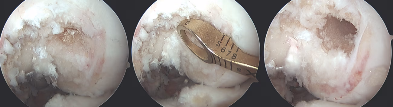 PCL femoral tunnel
