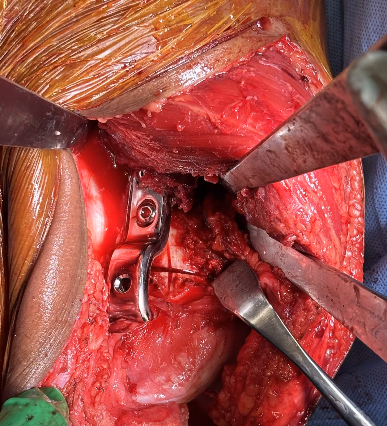 medial closign wedge