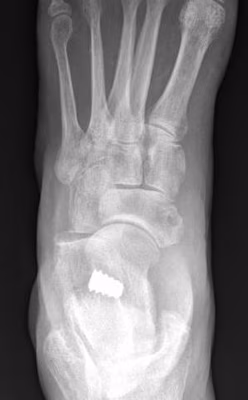 implant