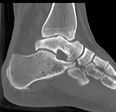 talus AVN