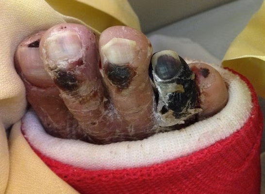 Gangrene