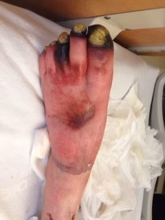 Gangrene