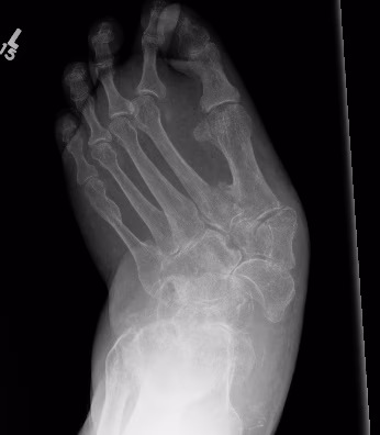 Charcot