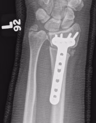 osteo