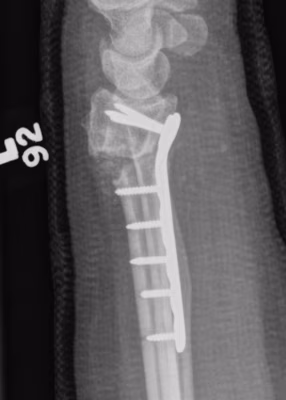 osteotomy