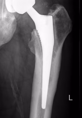 Loosening uncemented stem