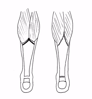 Achilles Tendon VY Turndown